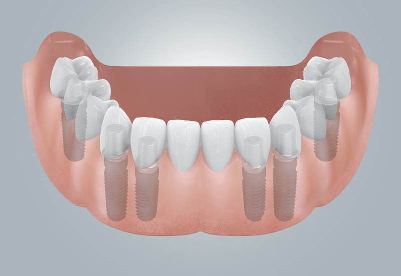 Implantate im Knochen schematisch dargestellt