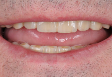 Festsitzende Zähne auf Implantaten