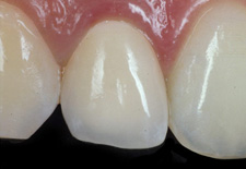 Festsitzende Zähne auf Implantataufbau