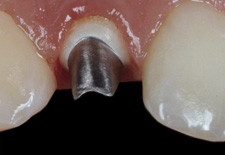Implantataufbau im Mund