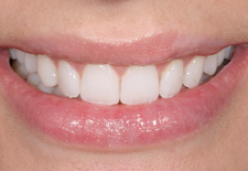 Veneers